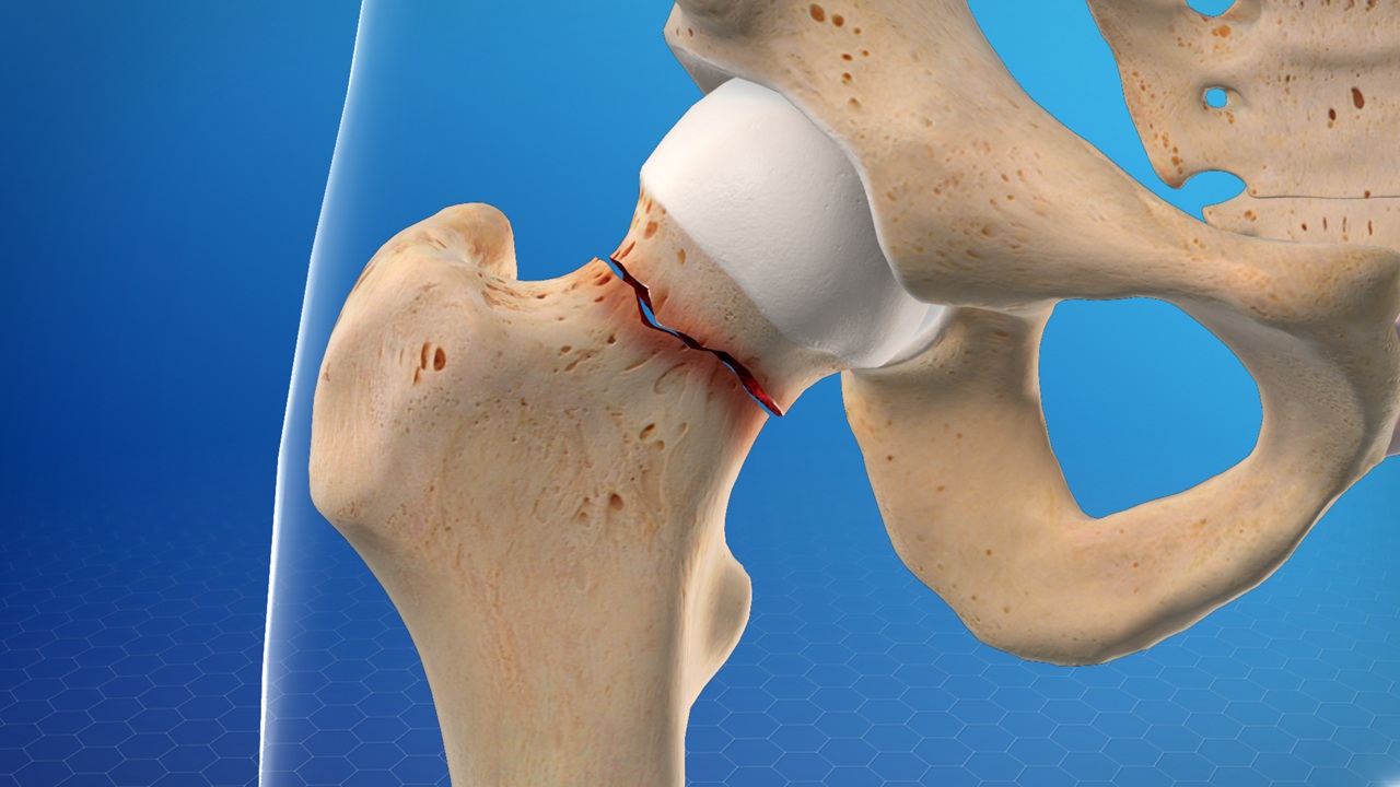 Hip Fracture Treatment in Malleswaram